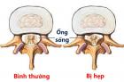 HẸP ỐNG SỐNG THẮT LƯNG GÂY NHIỀU BIẾN CHỨNG NGUY HIỂM