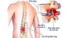 TRIỆU CHỨNG BỆNH THOÁT VỊ ĐĨA ĐỆM VÀ CÁCH ĐIỀU TRỊ CHỈ CẦN 20 PHÚT