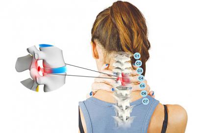 BIỆN PHÁP ĐIỀU TRỊ BỆNH THOÁI HÓA ĐỐT SỐNG CỔ KHỎI LÂU DÀI