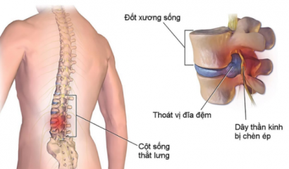 CHÈN ÉP RỄ THẦN KINH CÁCH CHỮA KHÔNG KHÓ NHƯ BẠN NGHĨ