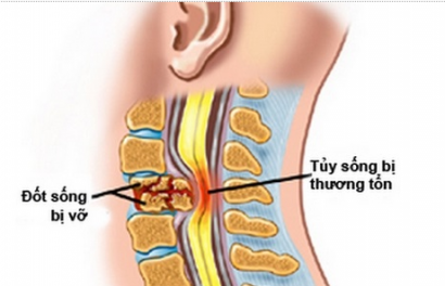 Tìm hiểu hội chứng chèn ép tủy sống