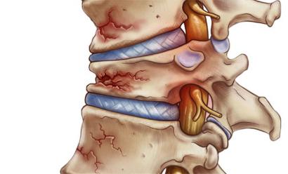 Lún Đốt Sống Nguyên Nhân và Cách Điều Trị Hiệu Quả